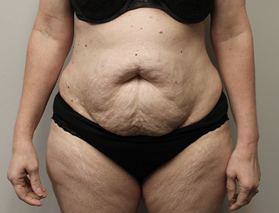 Tummy Tuck before and after - before