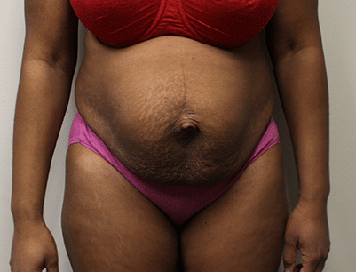 Tummy Tuck before and after - before