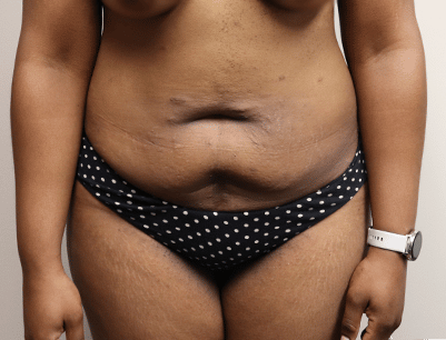 Tummy Tuck before and after - before