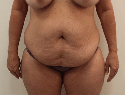 Tummy Tuck before and after - before