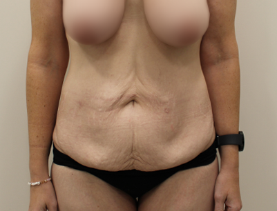 Tummy Tuck before and after - before