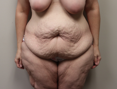 Tummy Tuck before and after - before