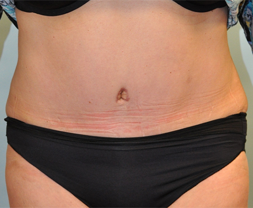 Tummy Tuck before and after - after
