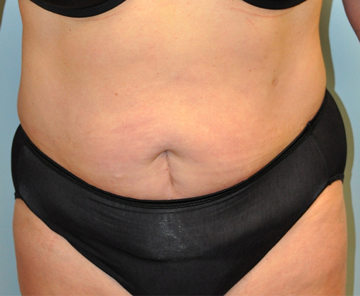 Tummy Tuck before and after - before