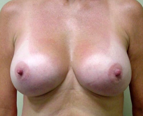 Breast Augmentation by Dr. Abhay Gupta — after