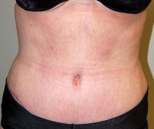 Tummy Tuck by Dr. Abhay Gupta — after
