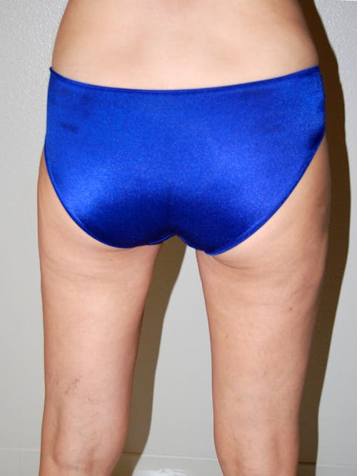 Liposuction before and after - after