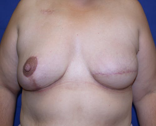 Other procedures by Dr. Abhay Gupta — after
