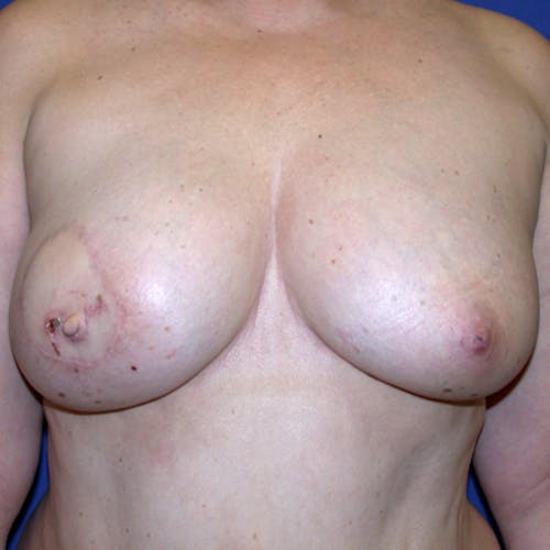 Other procedures by Dr. Abhay Gupta — after