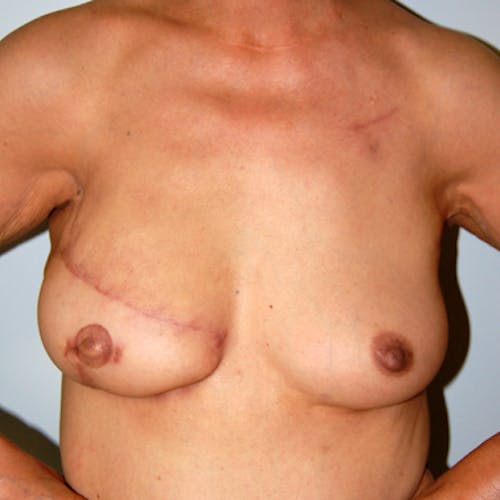Other procedures by Dr. Abhay Gupta — after