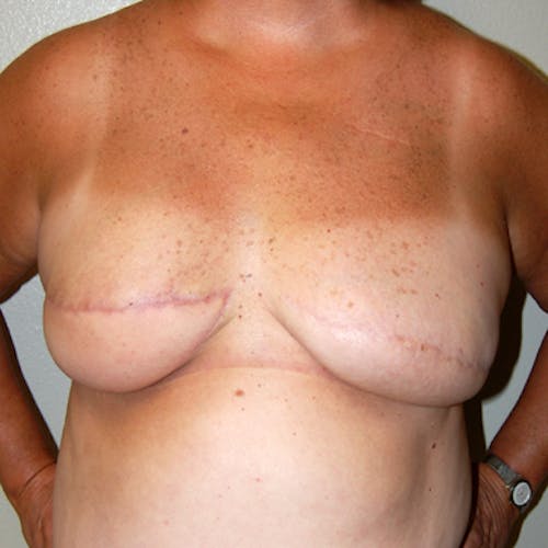 Other procedures by Dr. Abhay Gupta — after