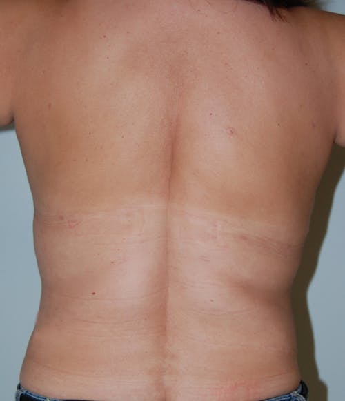Liposuction by Dr. Abhay Gupta — after