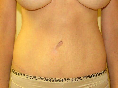 Tummy Tuck by Dr. Abhay Gupta — after