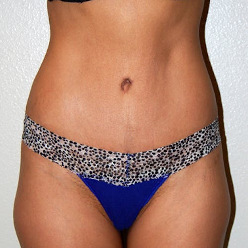 Tummy Tuck before and after - after