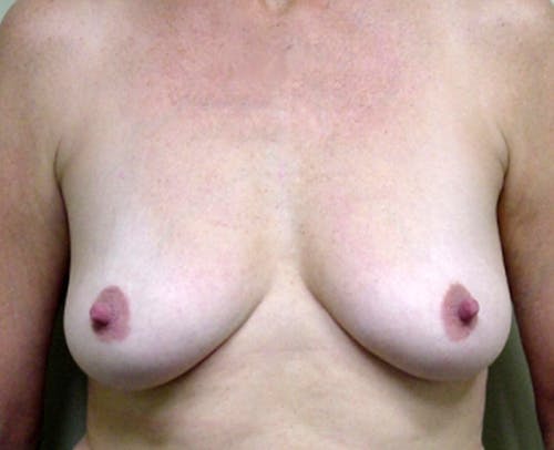 Breast Augmentation by Dr. Abhay Gupta — before