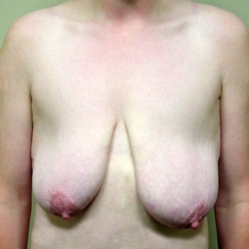 Breast Lift by Dr. Abhay Gupta — before and after