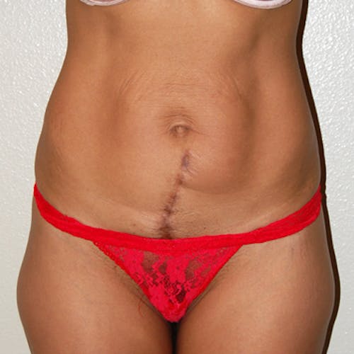 Tummy Tuck by Dr. Abhay Gupta — before and after