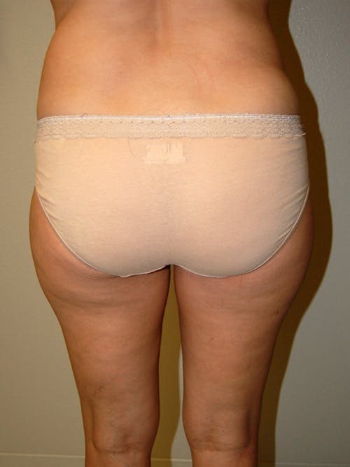 Liposuction by Dr. Abhay Gupta — before and after