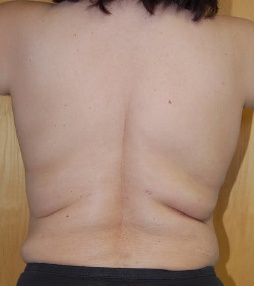 Liposuction by Dr. Abhay Gupta — before