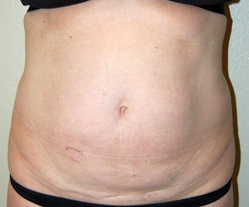 Tummy Tuck by Dr. Abhay Gupta — before