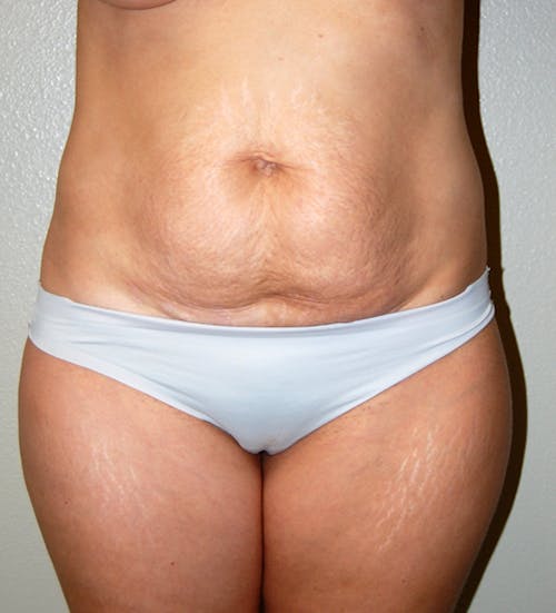 Tummy Tuck by Dr. Abhay Gupta — before