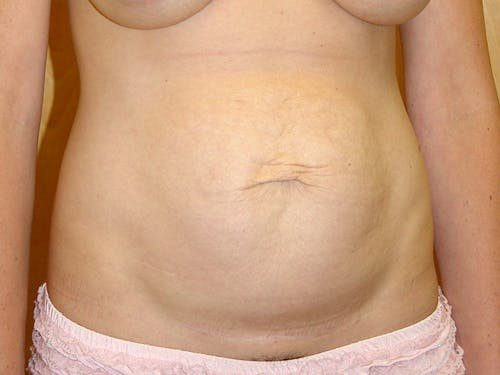 Tummy Tuck by Dr. Abhay Gupta — before
