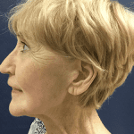 Procedure before and after - after