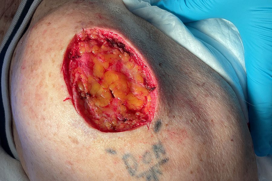 Mohs Surgery before and after - after