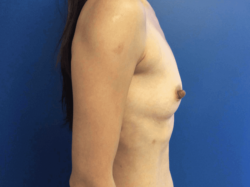 Breast Augmentation before and after - after