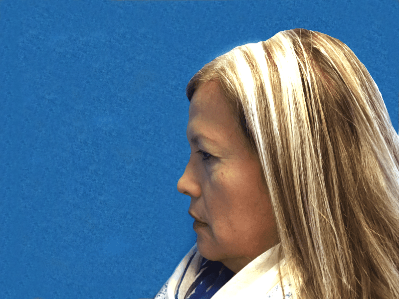 Blepharoplasty before and after - after