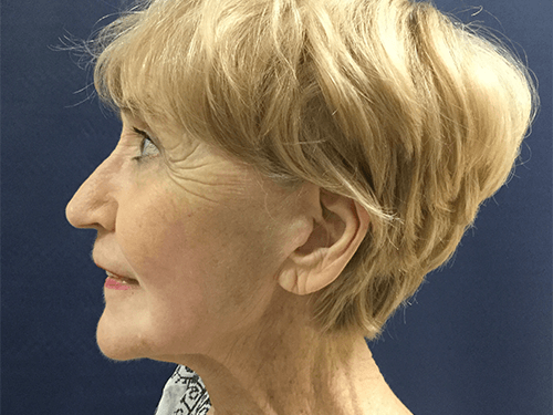 Procedure before and after - after