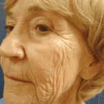 Procedure before and after - before