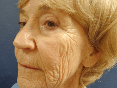 Procedure before and after - before