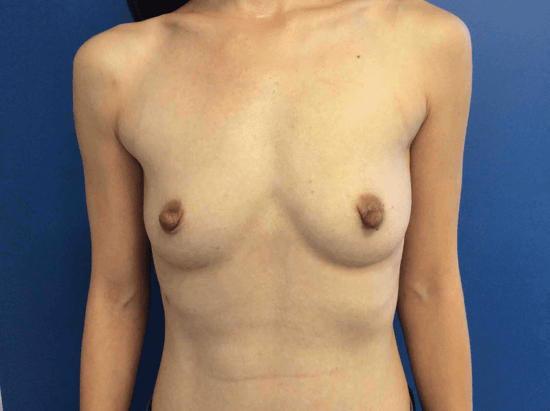 Breast Augmentation before and after - before