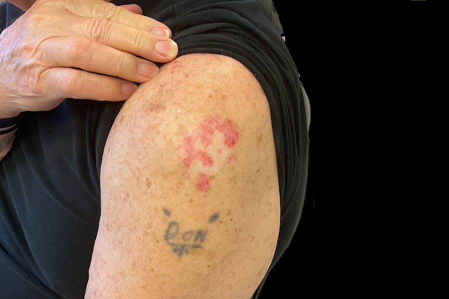 Mohs Surgery before and after - before