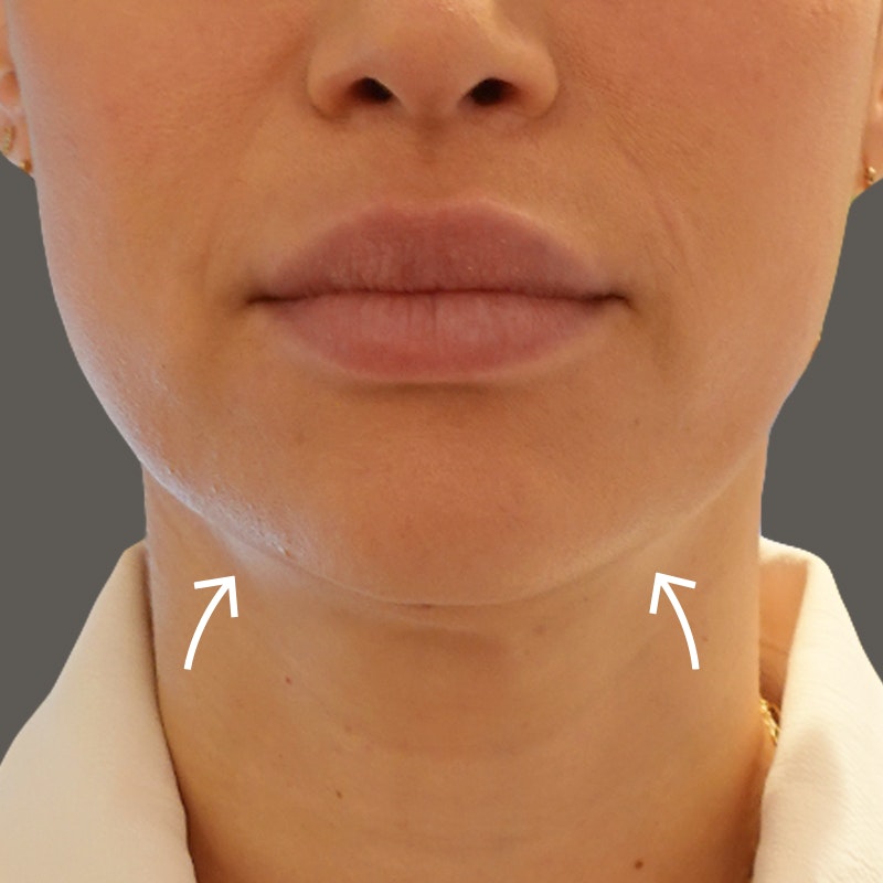 Chin before and after - after