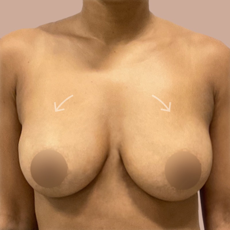 Fat Transfer Breast Augmentation before and after - after