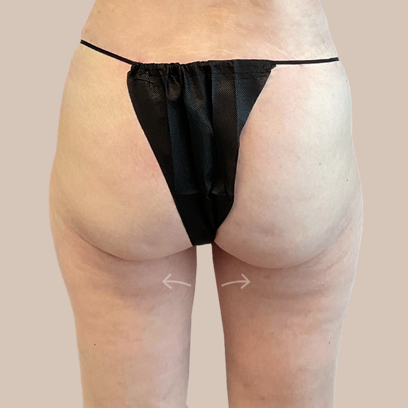 Thighs Airtite Female before and after - after