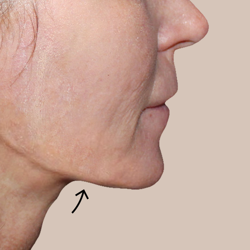 Chin before and after - after