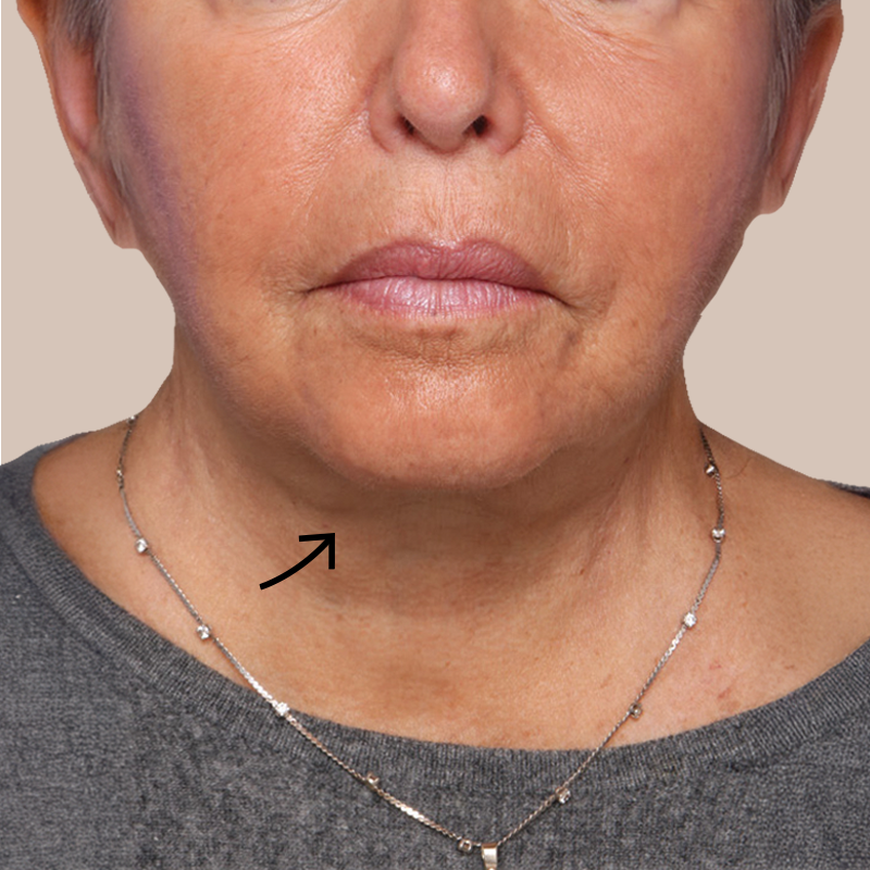 Chin before and after - after