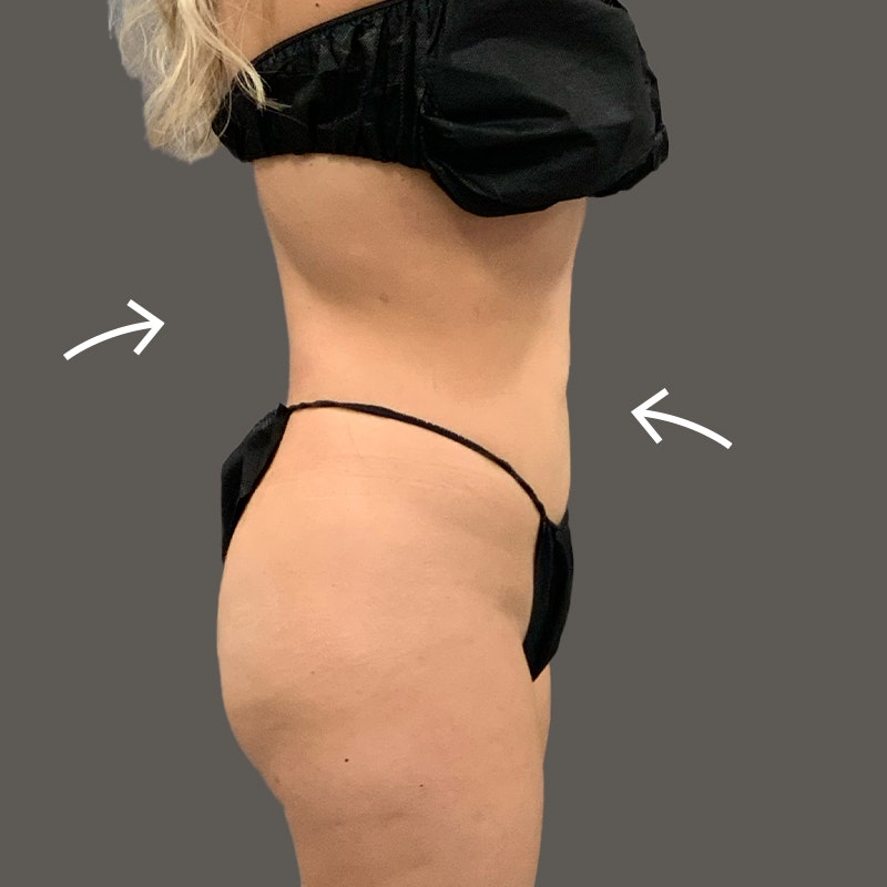 AirSculpt® before and after - after
