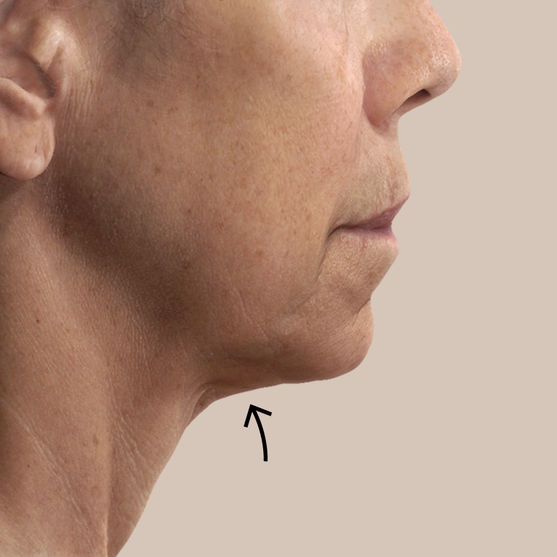 Chin before and after - after