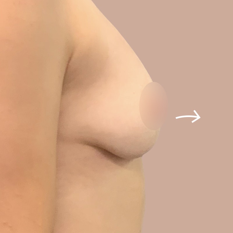 Fat Transfer Breast Augmentation before and after - after