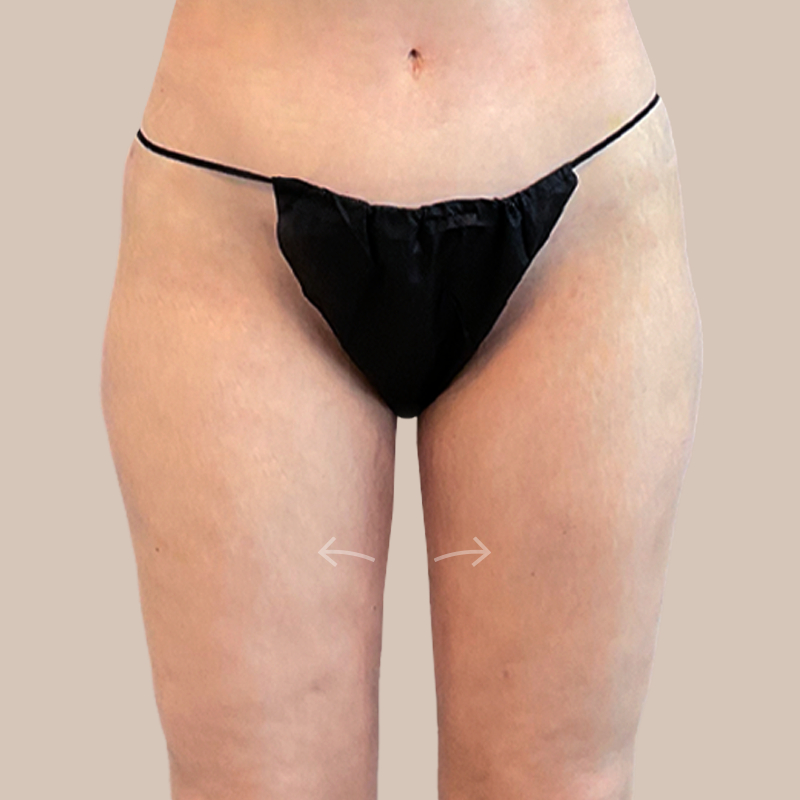 Thighs Airtite Female before and after - after