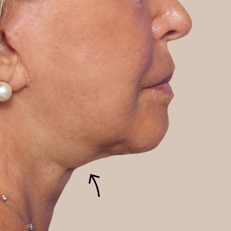 Chin before and after - after