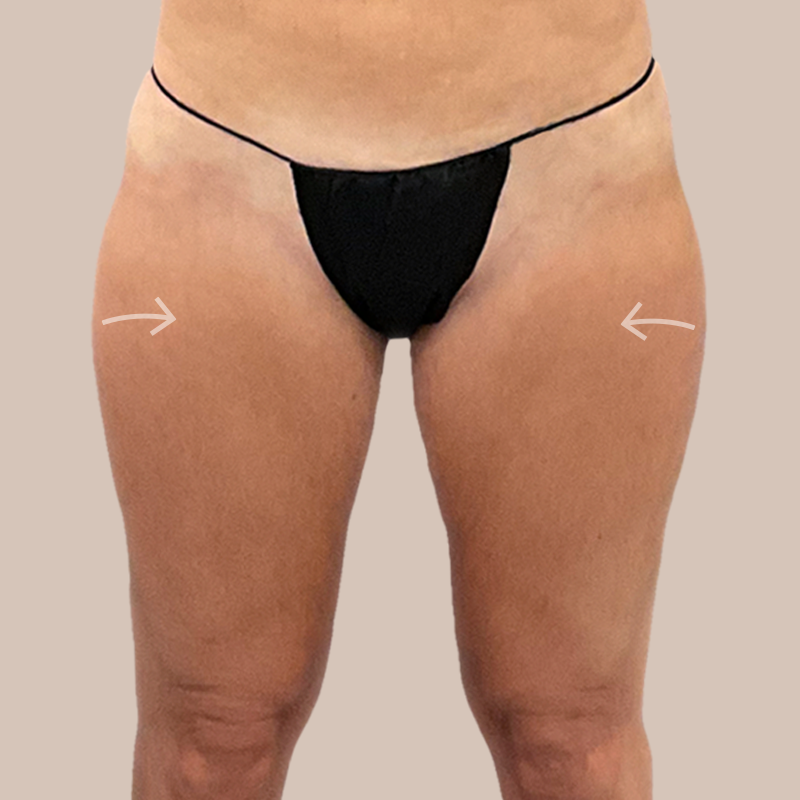 Thighs Airtite Female before and after - after