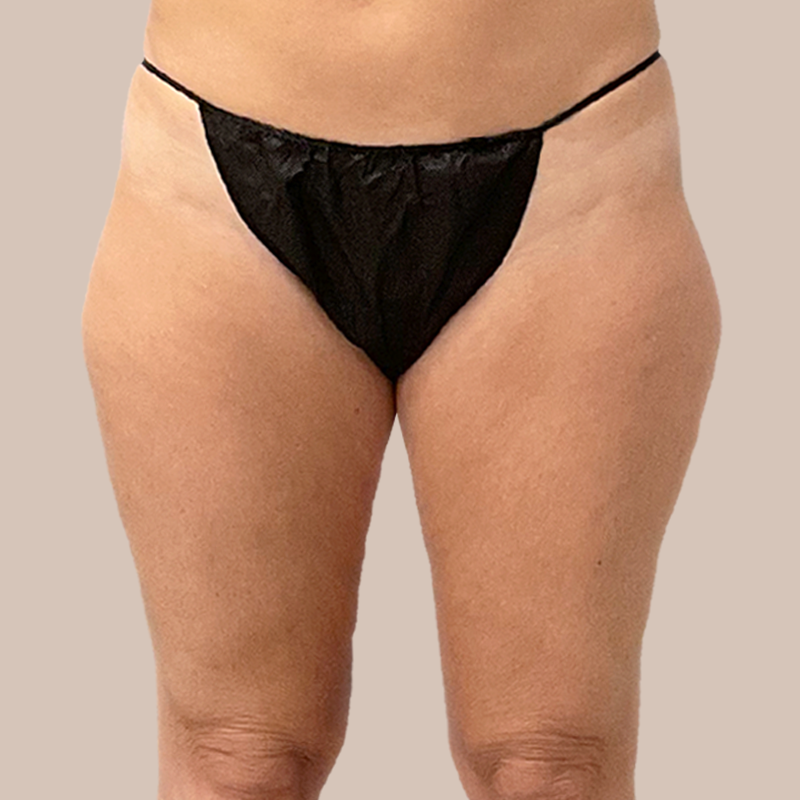 Thighs Airtite Female before and after - before