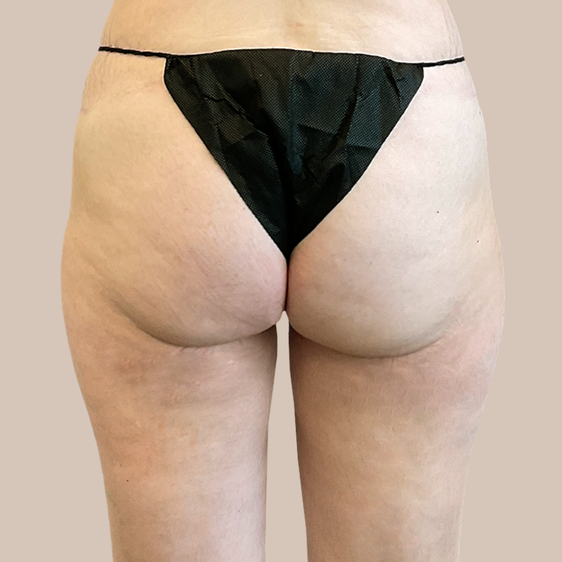 Thighs Airtite Female before and after - before