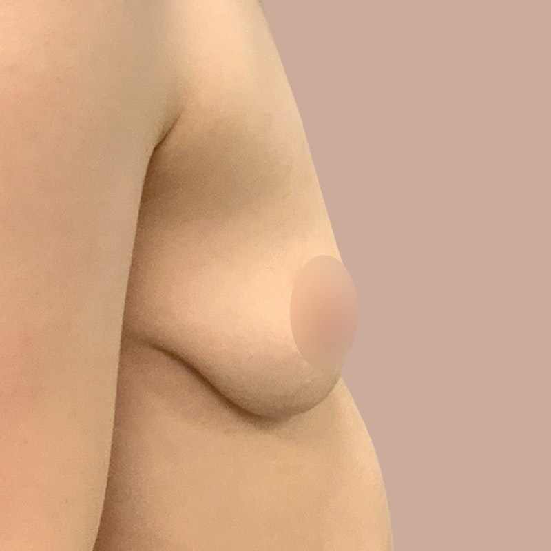 Fat Transfer Breast Augmentation before and after - before