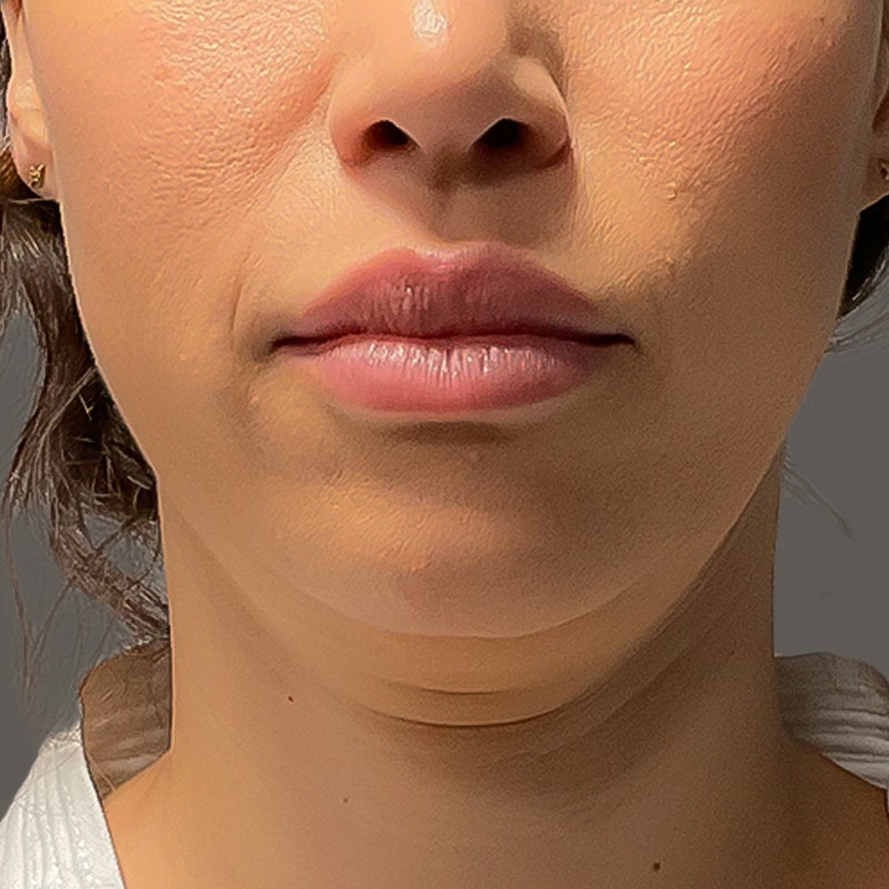 Chin before and after - before